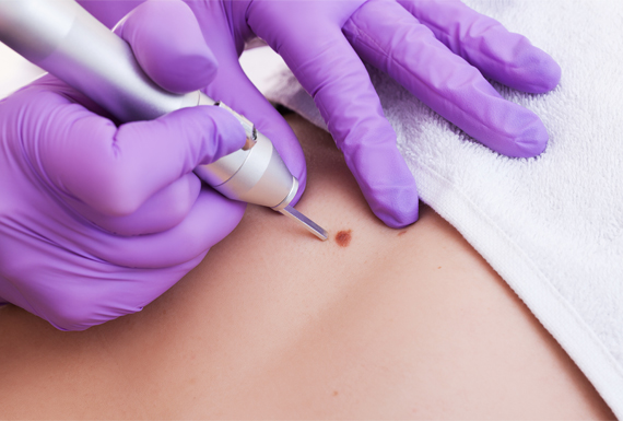 A person is getting their blood drawn with an electric device.